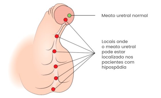 Hipospádia é uma condição congênita onde o meato uretral se encontra em posição mais proximal e ventral na haste peniana ou escroto.