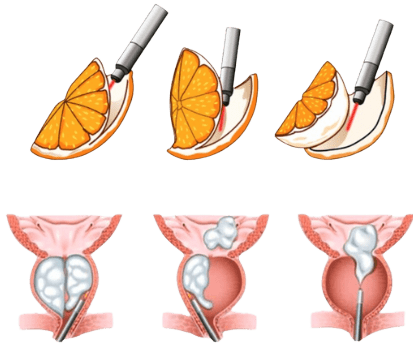 Enucleação da Próstata a Laser
