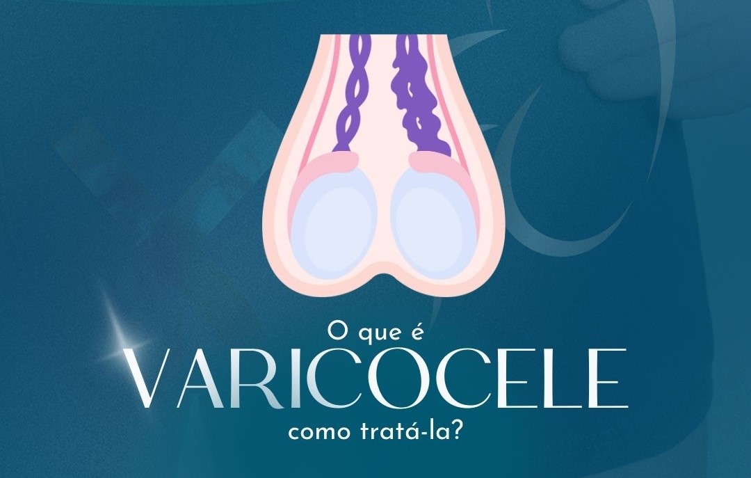 Varicocele