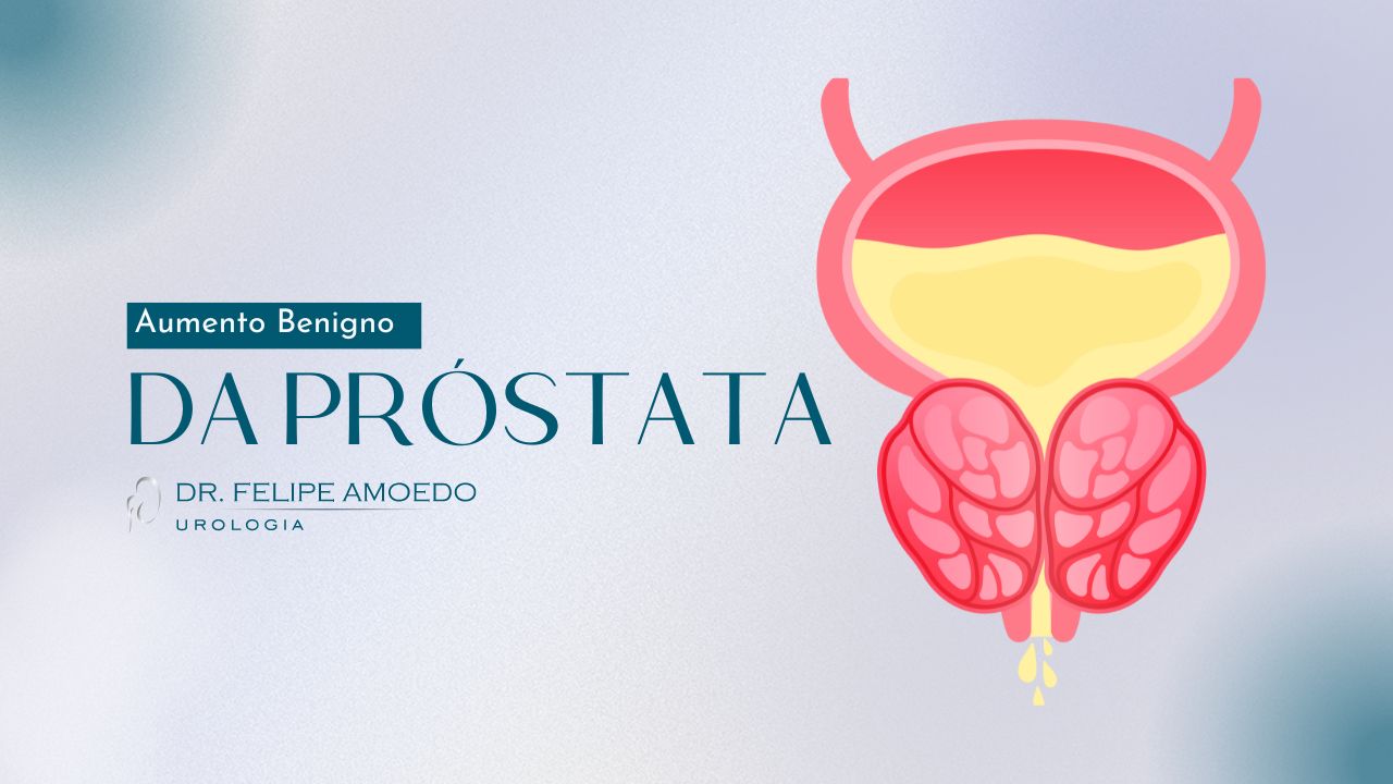 Aumento Benigno da Próstata – Hiperplasia Prostática Benigna (HPB)