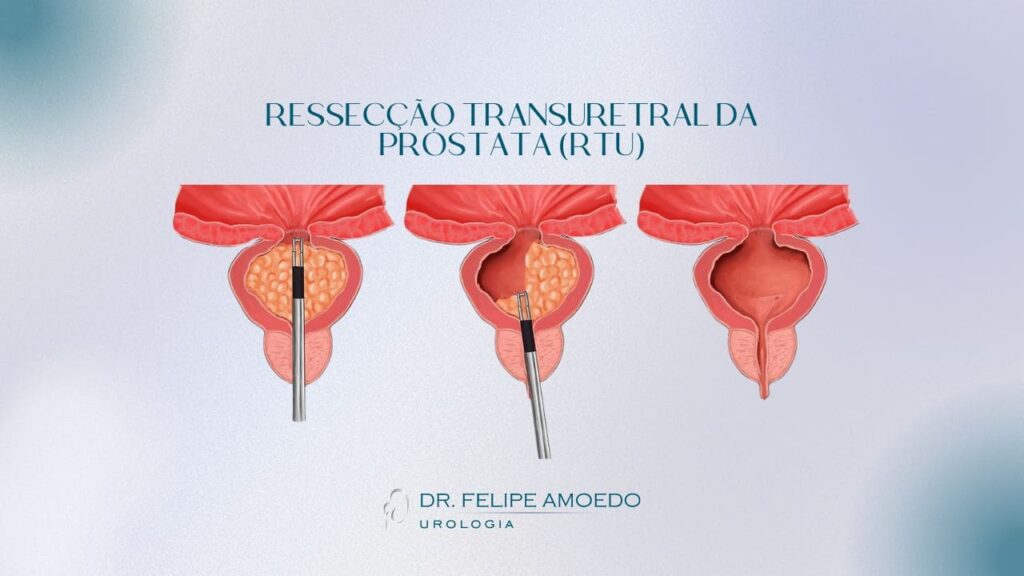 Resseccao-transuretral-da-prostata-RTU