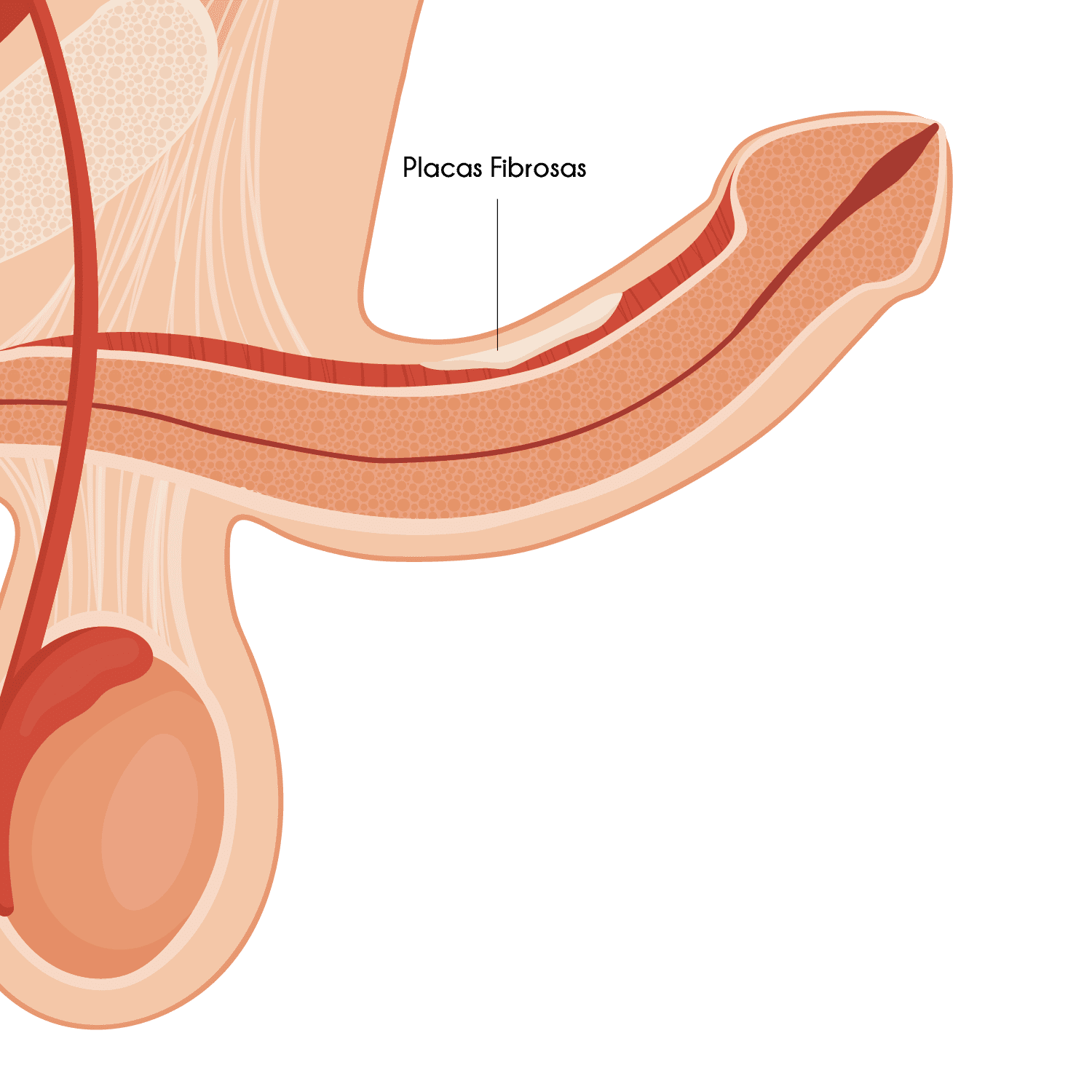 Curvatura Peniana Adquirida (Doença de Peyronie)